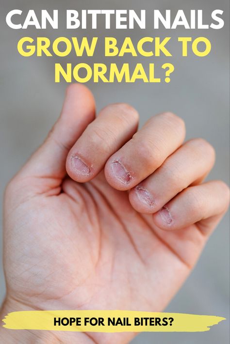 How To Quit Biting Your Nails, Nail Bed Damage Repair, Damaged Nail Bed, Nail Biters Before And After, Tips For Nail Biters, Nail Growth Tips For Nail Biters, Nail Picking Habit, Nails Biting, Stop Nail Biting Diy