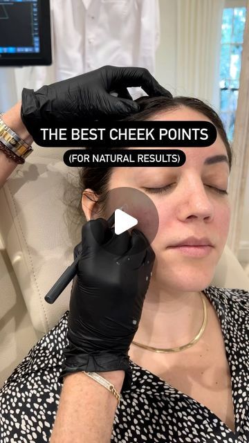 Cheek Filler Placement, Mid Cheek Filler, Cheek Filler Before And After, Cheekbone Filler Before And After, Cheek Fillers Before And After Face, Cheek Augmentation, Cheek Wrinkles, Aesthetics Business, Face Fillers