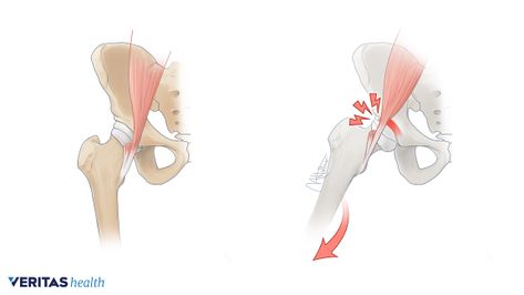 There are three ways snapping hip can originate. Each type of snapping hip, while typically harmless, may lead to pain and joint damage for some athletes. Snapping Hip Syndrome, Psoas Release, Hip Flexor Exercises, Bursitis Hip, Hip Injuries, Muscle Stretches, Hip Problems, Hip Flexor Stretch, Psoas Muscle