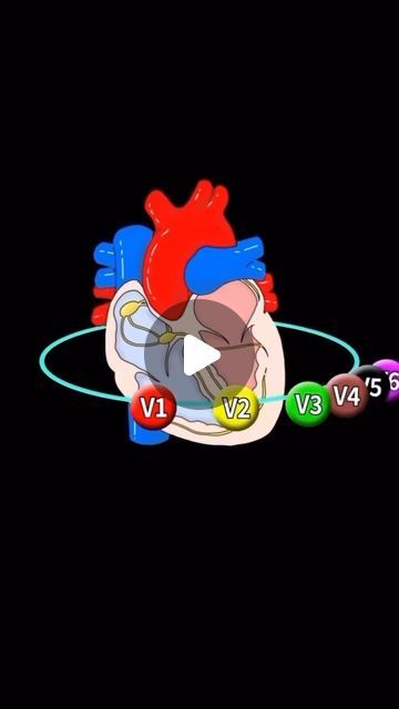 Jay Mohan on Instagram: "USE THE MAP- EKG basics 

💡 To be good at EKG interpretation you need to have a solid foundation and you have to be dedicated to looking at thousands of them (and be ok with getting a bunch wrong- as everyone in medicine does). Every patient you ever see you should be individually assessing the EKG. Do your best to avoid looking at the computer read! I don’t know how many times I get called based on the computer read for MIs, Afib, etc. If you know basics you can get through the majority of an EKG. Leave the advanced tracings to cardiology, but every physician to be able to get through the basics (rate, rhythm, axis, intervals, ST segments)

🗺️ To understand EKGs you have to understand the map. The key to the map is knowing where the leads are located on the body Telemetry Nursing, Ekg Interpretation, Med Student, Cardiology, Med School, Medical Education, Do Your Best, Medical School, I Don T Know