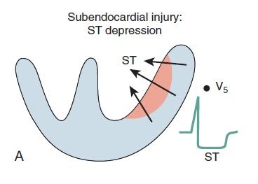 Cardiac Anesthesiologist: Subendocardial vs Transmural Myocardial Ischemia. Myocardial Ischemia, Pie Chart, Health, Quick Saves