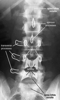 Radiographic Anatomy of the Skeleton: Lumbar Spine -- AP View, Labelled Radiographic Anatomy, Radiography Student, Radiology Schools, Medical Radiography, Radiology Humor, Radiology Student, Radiology Technician, Radiology Imaging, Anatomy Bones