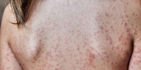 Hives Vs. Rash: How to Tell the Difference Heat Rash Remedy, Allergy Hives, Keto Rash, Types Of Skin Rashes, Allergy Rash, Chronic Hives, Skin Fungus, Types Of Rashes, Itchy Rash