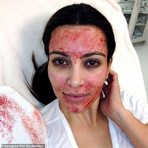 The One Day At A Time actress, 61, was makeup free with a very red face after getting a Vampire Facial, which was made popular by Kim Kardashian on Keeping Up with the Kardashians. Vampire Facial, Aesthetic Medicine, Beauty Treatments, Funny Posts, Kim Kardashian, Funny Texts, Really Funny, Medicine, A Woman