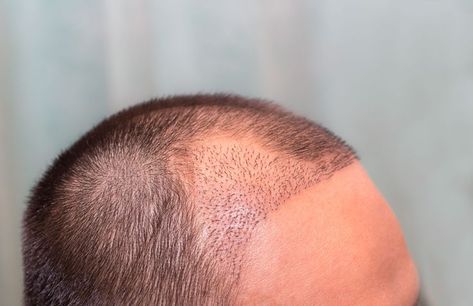 When Is The Right Time To Have A Hair Transplant How To Contour Your Face, Hair Transplant Surgery, Herbal Hair, Laser Therapy, Hair Starting, Hair Scalp, One Hair, Hair Transplant, Hair Restoration