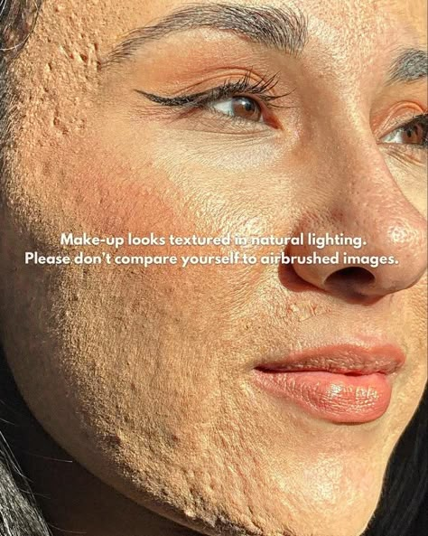 Real Makeup Texture, Real Skin Texture Makeup, Girl With Acne, Acne Positivity, Heat Rash, Real Bodies, Cute Tumblr Pictures, Remove Dark Spots, Skin Care Solutions