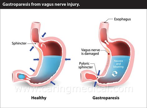 Gastroperisis Diet, Cervical Instability, Digestion Tips, Nerf Vague, Gastric Problem, Stop Acid Reflux, Gastrointestinal Disease, Fast Workouts, Cervical Spine