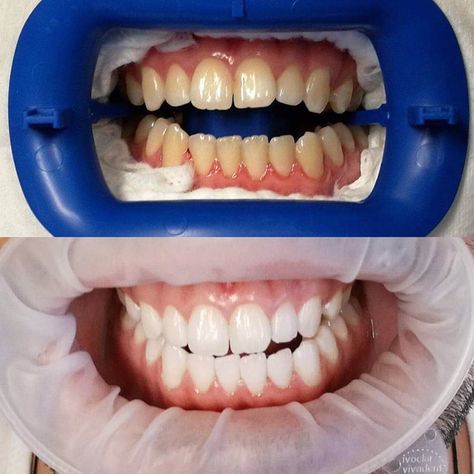 We love before and after pics from our Phillips Zoom! In chair whitening patients! Trent's smile is looking super bright! Can someone pass me the sunnies? Please note that all individual results may vary :) #love #ZoomWhitening #VogueDentalStudios #Blackburn #Melbourne #results #BeforeandAfter #resultsmayvary #inchairwhitening #Blackburn #Melbourne #Templestowe #Doncaster #allsmiles #laughter #patients #happiness Zoom Teeth Whitening, Zoom Whitening, Before And After Pics, Before And After Pictures, All Smiles, Teeth Whitening, Sunnies, Melbourne, Quick Saves