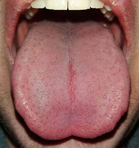 Cleaning your tongue - why and how. Tongue Problems, Oral Pathology, Tongue Health, Nail Care Tips, The Tongue, Organic Health, Healthy Juices, Oral Hygiene, Baby Hacks