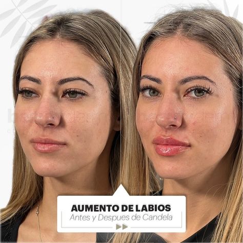 Ella es nuestra paciente Candela y queremos compartirte su antes y después 😁 Le realizamos un aumento de labios para alcanzar el grosor deseado 👄 En Beautyderm siempre buscamos resultados naturales que destaquen la belleza de cada paciente✨ ¿Qué te parece este antes y después? ⏩ Te leemos en comentarios. 📍Pedí un turno para comenzar 📱 11 5494 3993 #aumentodelabios #rellenodelabios #rostroiluminado #volumenenlabios #hidrataciondelabios #medicinaestetica #esteticaargentina April 26, On Instagram, Instagram