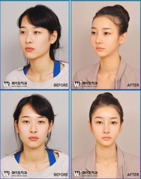 V Line Surgery, Fenugreek For Hair, Korean Beauty Standards, V Line Face, Korean Plastic Surgery, V Shape Face, Face Surgery, Rhinoplasty Surgery, Nose Shapes