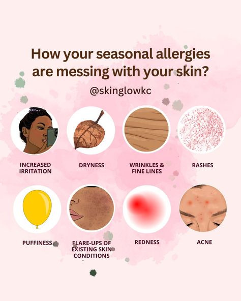 Seasonal allergies can wreak havoc on your skin, causing acne, redness, dryness, and puffiness. They can also lead to wrinkles, fine lines, rashes, increased irritation, and flare-ups of existing conditions. 😣 Understanding how allergies impact your skin is the first step towards finding relief. Let’s address these concerns together and create a customized skincare routine to soothe and heal your skin. 💖🌿 Ready for calm, radiant skin? Book a facial or skin consultation now and start your jo... Skin Consultation, Acne Redness, Seasonal Allergies, Skin Conditions, Esthetician, Radiant Skin, First Step, Skincare Routine, Allergies