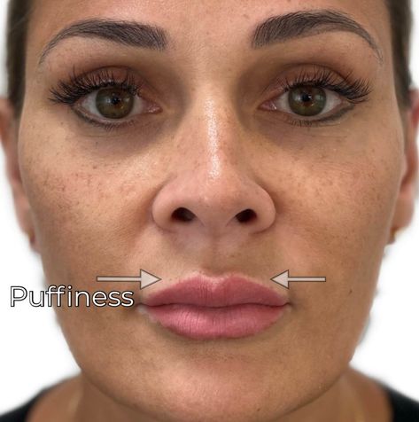 Lip Filler Swelling, Vermillion Border Lip Filler, Bruising After Lip Filler, Lip Fillers Migration, Migrated Lip Filler, Lip Filler Swelling Day By Day, .5 Syringe Lip Filler, Lip Fillers Bruising, Filler Migration Lips