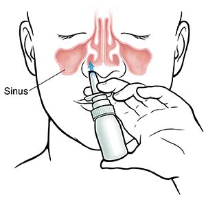 When using nasal spray, keep your chin down and angle the spray away from center. Ear Nose Throat, Nasal Decongestant, Cold Or Allergies, Allergy Medicine, Sinus Problems, Sinus Headache, Nasal Cavity, Nasal Passages, Nasal Spray