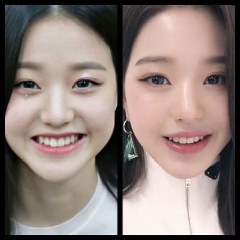 Wonyoung Before And After Surgery, Wonyoung Predebut, Korean Surgery, Kpop Plastic Surgery, V Line Surgery, Korean Plastic Surgery, Korean Lips, Laptop Backpack Women, Clear Glowing Skin