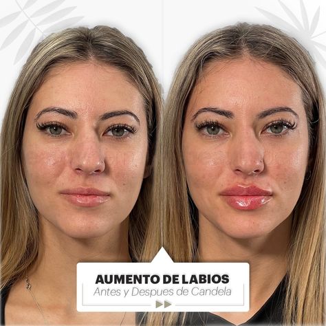 Ella es nuestra paciente Candela y queremos compartirte su antes y después 😁 Le realizamos un aumento de labios para alcanzar el grosor deseado 👄 En Beautyderm siempre buscamos resultados naturales que destaquen la belleza de cada paciente✨ ¿Qué te parece este antes y después? ⏩ Te leemos en comentarios. 📍Pedí un turno para comenzar 📱 11 5494 3993 #aumentodelabios #rellenodelabios #rostroiluminado #volumenenlabios #hidrataciondelabios #medicinaestetica #esteticaargentina