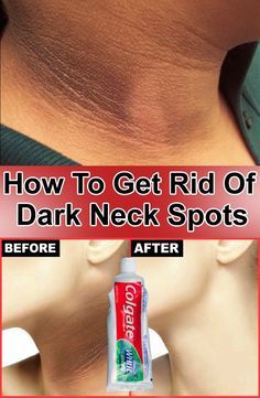 How To Whiten Dark Neck, Neck Whitening Remedies, Skin Treatments For Whitening, Get Rid Of Dark Neck, Pigmentation Remedy, Whitening Face Mask, Dark Neck, Face Whitening, Natural Remedies For Migraines