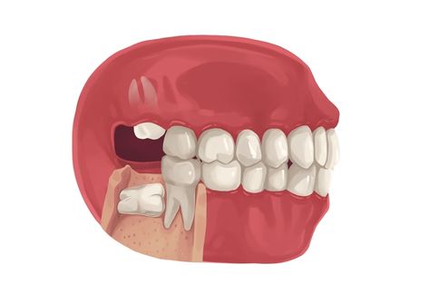 Wisdom Teeth Removal Recovery, Teeth After Braces, Impacted Wisdom Teeth, Teeth Surgery, Cracked Tooth, Dental Extraction, Dental Tips, Wisdom Tooth, Dental Insurance Plans