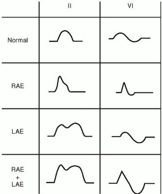 Biphasic P Wave | ... component of p wave in v1 1 5 mm tall and prominent p terminal force Ekg Rhythms, Cardiac Sonography, Medical School Interview, Ekg Interpretation, P Wave, Indian Yoga, Pharmacology Nursing, Respiratory Therapy, Medical Facts