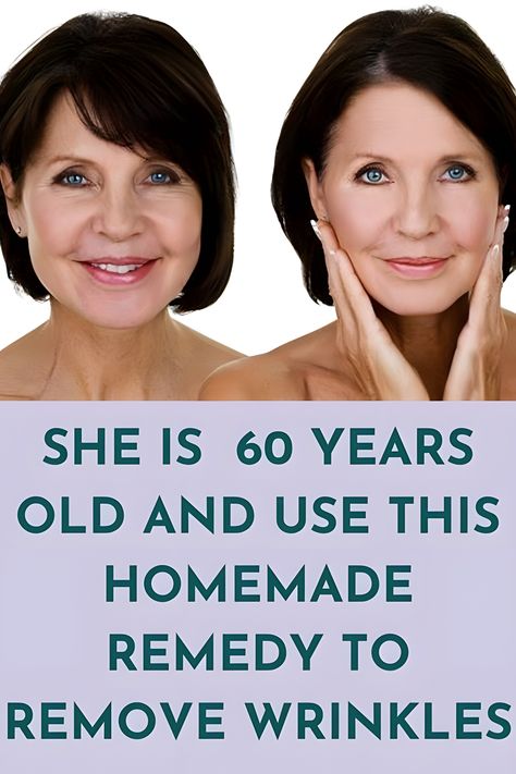 She is 60 years old and use this homemade remedies to remove wrinkles Wrinkles Around Mouth, Mouth And Eyes, Mouth Wrinkles, Anti Aging Remedies, Wrinkle Remedies, Wrinkle Free Skin, Skin Care Wrinkles, Face Wrinkles, Saggy Skin