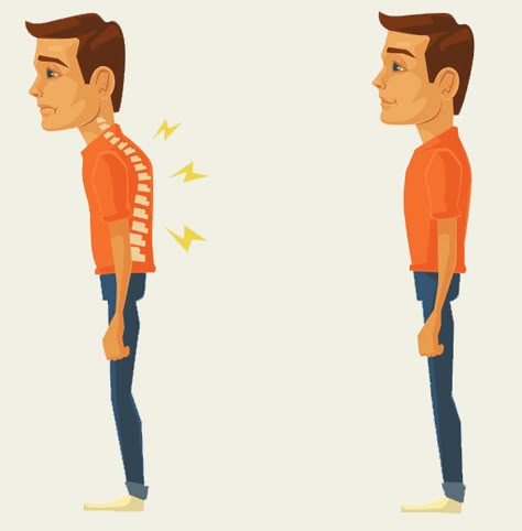 Hunchback Posture, Dowager's Hump, Posture Correction Exercises, Better Posture Exercises, Neck And Shoulder Exercises, Neck Hump, Forward Head Posture, Back Stretches For Pain, Simple Exercise