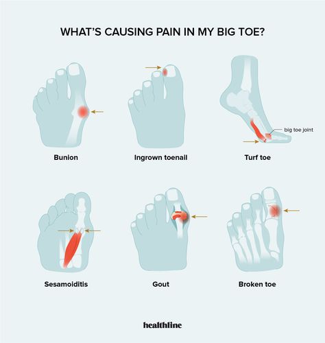 Causes of Sharp Pain in Big Toe and When to Contact a Doctor Achilles Tendon Pain Relief, Bottom Of Foot Pain Chart, Big Toe Pain, Strengthen Patellar Tendon, Soccer Injuries, Knee Bones, Achilles Pain, Round Ligament Pain, Trigger Point