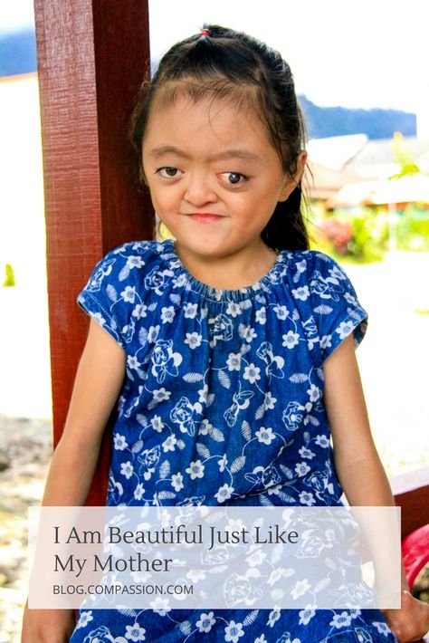 Born with a rare genetic disorder called Apert syndrome, 7-year-old Karunia in East Indonesia radiates self-confidence and beauty. Apert Syndrome, Down's Syndrome, Rare Genetic Disorders, Compassion International, Smile Lines, Genetic Disorders, I Am Beautiful, Special Needs Kids, Baby Born