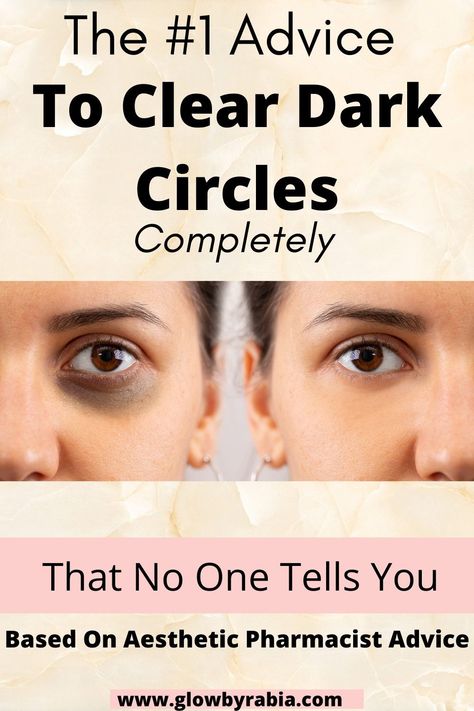 Do you struggle to understand what is causing your under eye dark circles? Have you tried many serums and products for under eye dark circles with little benefit? The key to dark circles treatments is understanding the cause which is explained in this post by a dermatology pharmacist. Under eyes dark circles| Under eye bags| How to get rid of dark circles fast| How to get rid of dark circles overnight| Dark circles remedies| best eye serums for dark circles| dark circles treatments How To Reduce Under Eye Darkness, How To Fix Dark Circles, Get Rid Of Dark Circles Under Eyes, Dark Circle Remedies Overnight, Dark Circles Under The Eyes Remedies, Dark Circles Remedies, Remove Eye Wrinkles, Best Eye Serum, Under Eye Dark Circles