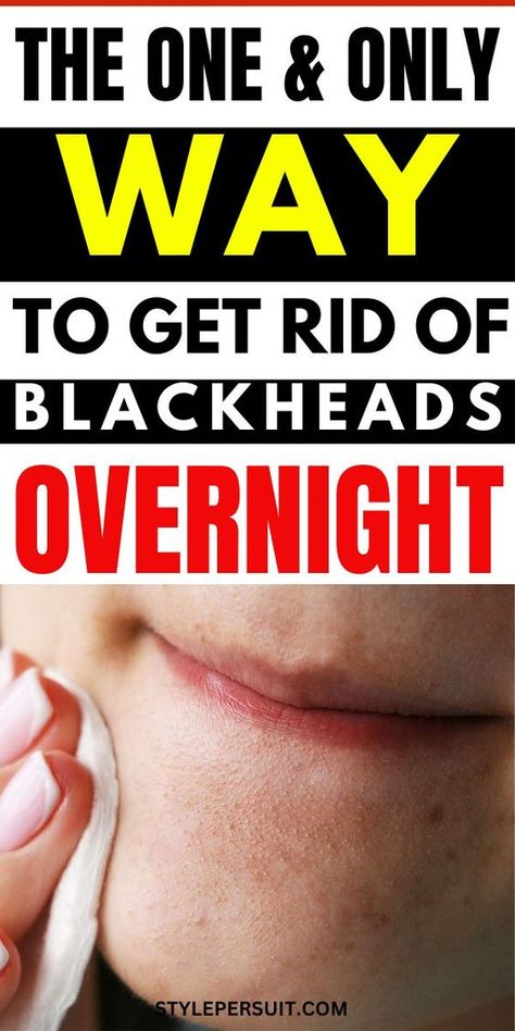 HOW TO GET RID OF BLACKHEADS: 6 EFFECTIVE WAYS & TIPS FOR CLEAR SKIN | YOURGIRLKNOWS Blackhead Remover Diy, Blackhead Remedies, Nail Problems, Blackheads On Nose, Rid Of Blackheads, Blackhead Mask, Face Care Routine, Types Of Acne, Get Rid Of Blackheads