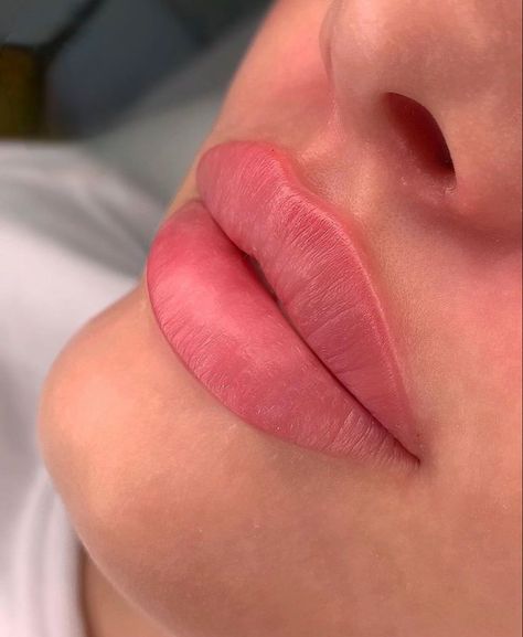 M Shape Lips, 1ml Lip Filler, Lip Goals, Lip Aesthetic, Dermal Fillers Lips, Juvederm Lips, Lip Plumping Balm, Lips Inspiration, Botox Lips