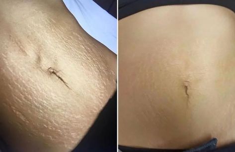 Stretch Mark Microneedling, Laser Scar Removal Before And After, Remove Strech Mark, Laser Stretch Mark Removal, Best Stretch Mark Cream, Pmu Eyebrows, Stretch Mark Removal Cream, Stretch Mark Cream Pregnancy, Stretch Mark Remedies