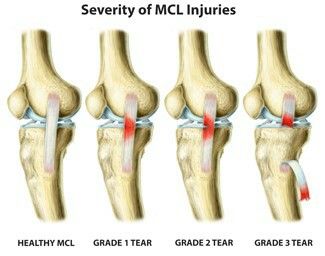 Due to attachment of the MCL on the medial meniscus, MCL sprains may also have an associated medial meniscus tear. An MCL sprain occurs when there is a direct force applied to the outside of the knee, pushing the knee inward. MCL sprains may also occur when a person sustains an ACL (anterior cruciate ligament) tear. There are 3 grades of sprains. A grade one sprain involves stretching and minor tearing of the MCL fibers; a grade two sprain involves partial (50%) tearing; Mcl Tear, Knee Injury Recovery, Common Knee Injuries, Mcl Injury, Knee Surgery Recovery, Knee Ligaments, Anterior Cruciate Ligament, Knee Pain Exercises, Ligament Tear