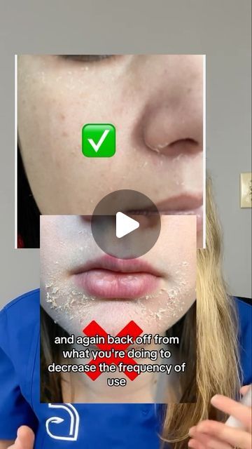 Dr. Abigail Waldman, MD FAAD on Instagram: "Curious about how long it will expect to see results from tretinoin? 

Dermatologist review of how long it will take to see results from tretinoin for acne, hyperpigmentation, skin texture and wrinkles. 

Also find out when to expect some of the common early side effects and know what’s normal and what’s not. 

Follow for more skin care tips. 

#acne #acnetreatment #tretinoin #antiaging #skincare #hyperpigmentation" Tretinoin Before And After Acne, Tretinoin Acne, Tretinoin Before And After, Skincare Hyperpigmentation, Before And After Acne, Acne Hyperpigmentation, How To Reduce Pimples, Antiaging Skincare, Pimple Marks