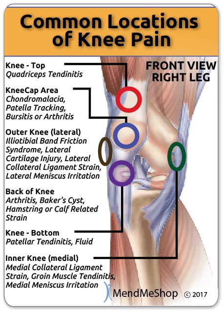 Knee pain can occur at several places in the joint depending on the injury or condition. Patellar Chondromalacia, Common Knee Injuries, Osgood Schlatter Disease, Knee Ligament Injury, K Tape, Knee Ligaments, Knee Pain Exercises, Ligament Injury, Knee Exercises