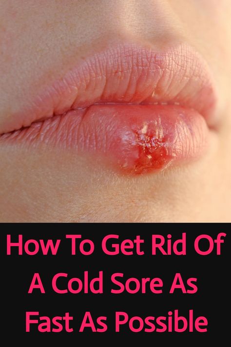 Save this pin to learn how to get rid of a cold sore with remedies and prevention tips from a lifelong cold sore sufferer! From effective treatments to practical prevention strategies, discover the best ways to manage and prevent cold sores. Cover Up Cold Sore, Cold Sore Remedy Fast, Cold Sore Remedy Overnight, Fever Blister Remedy, Cold Sore Essential Oil, Cold Sore Remedies, Cold Sore Lip, Home Remedies For Cold, Cold Sore Prevention