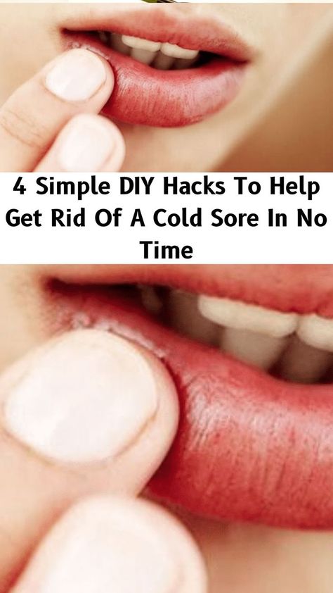 Best Cold Sore Remedy Overnight, Quick Cold Sore Remedy, Cold Sore Remedy Overnight How To Get Rid, Cold Sores Remedies Overnight, How To Get Rid Of A Cold Sore Fast, How To Get Rid Of Cold Sores, How To Get Rid Of Cold Sores Overnight, Coldsore Remedies Overnight, Canker Sore Remedy Overnight