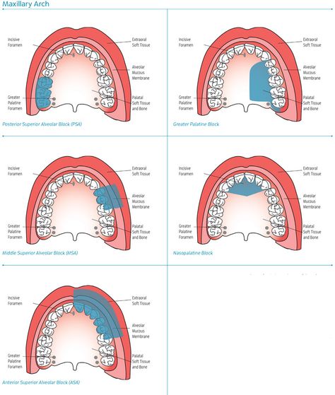 Maxillary Injection Sites Dental Anesthesia Injection Sites, Coronal Polishing Dental, Dental Anesthesia Injection, Dental Assistant School, Injection Sites, Dental Hygienist School, Local Anesthesia, Hygiene School, Dental Assistant Study