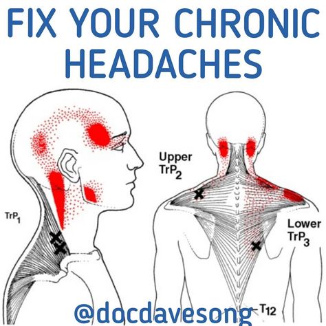 Punkty Spustowe, Referred Pain, Middle Back Pain, Headache Types, Trigger Point Therapy, Head Pain, Trigger Point, Neck Pain Relief, Neck And Shoulder Pain