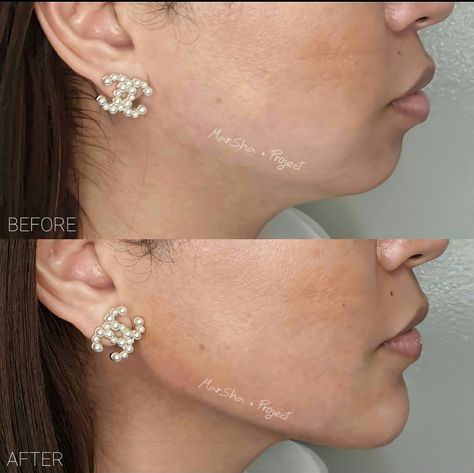 Beauty Procedures Aesthetic, Jawline Contouring Filler, Jaw Line Fillers Before And After, Jaw Filler Before And After, Jaw Filler, Eye Lift Surgery, Jawline Contouring, Jawline Filler, Face Injections