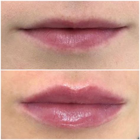 I've Got Small Lips But Im Worried About Getting Lip Fillers - L1P Aesthetics 1ml Lip Filler, Juvederm Lips, Botox Before And After, Lips Inspiration, Light Makeup Looks, Facial Contouring, Small Lips, Lip Enhancement, Lip Filler