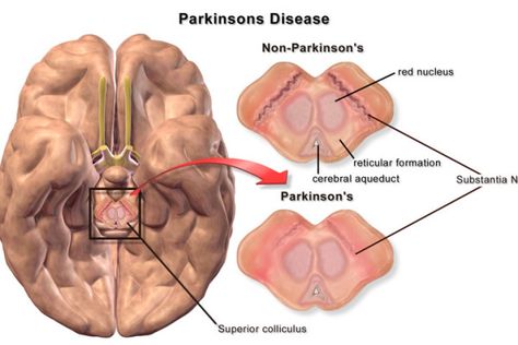 #Parkinson’s Disease Brain with Substantia Nigra | Neuroscience News Research Articles Substantia Nigra, Deep Brain Stimulation, Disease Symptoms, Neurological Disorders, Human Brain, Neurology, Alzheimers, Neuroscience, The Brain