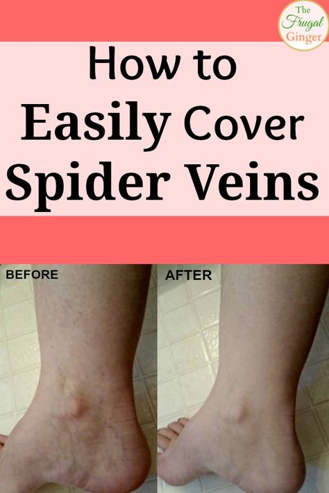 Spider veins make you self-conscious? Easily hide your spider veins with this simple technique. Spider Vein Cover Up, Leg Makeup For Veins Cover Up, Spider Vain On Leg, Spider Vein Essential Oil, How To Cover Veins On Legs Spiders, Natural Spider Vein Remedies, Spider Vein Remedies, Vericous Veins Exercises, Biggest Insecurities