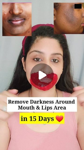 Shalini ♥️ Skin & Hair care 💁‍♀️ on Instagram Pigmentation Around Mouth Remedies, How To Remove Pigmentation Around Mouth, How To Remove Darkness Around Mouth, Dark Spots Around Mouth, Remove Darkness Around Mouth, Neck Pigmentation, Dark Skin Around Mouth, Darkness Around Mouth, Pigmentation Remedy