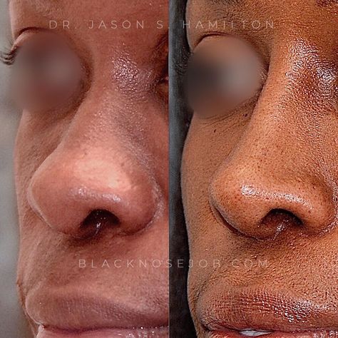 Nubian Nose, Natural Nose Job, Nose Goals, African Nose, Turning 22, Ethnic Rhinoplasty, Nose Jobs, Rhinoplasty Before And After, Aesthetic Dermatology