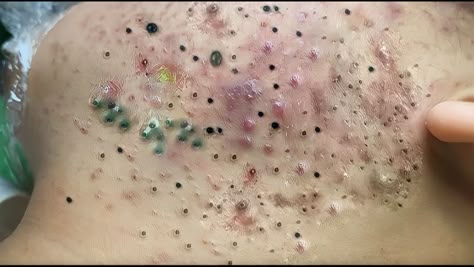 ALL THE HAPPINESS YOU WILL FIND HERE #1 Chin Blackheads Removal, Staphylococci Bacteria Infection On Skin, Pimple Location Meaning, Pimples On Face Removal, Cystic Acne Removal Video, Trypophobia Hand, Backne Remedies Fast, Black Heads Removal Homemade, Skin Diseases Pictures