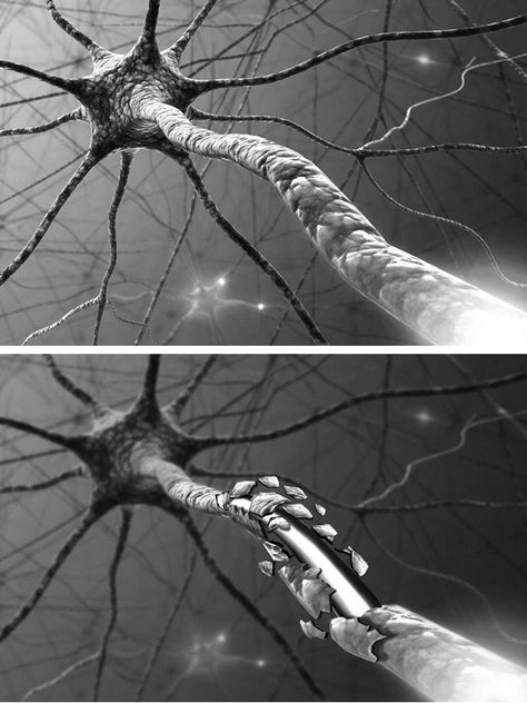 Neuron Synapse, Synaptic Pruning, Dark Cottagecore Aesthetic, Brain Neurons, Guillain Barre, Guillain Barre Syndrome, The Peripheral, Microscopic Photography, Peripheral Nervous System