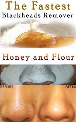 Covering Acne, Skin Moles, Black Heads, Clear Skin Tips, Acne Remedies, How To Get Rid Of Acne, Skin Care Recipes, Skin Care Solutions, Diy Skin Care