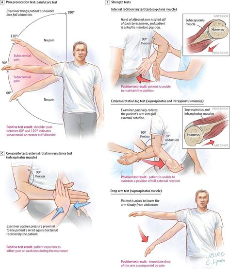 JAMA Network on Instagram: “Rotator Cuff Disease – Physical Exam A positive painful arc test result and positive external rotation resistance test result are most…” Shoulder Special Tests, Rotator Cuff Exercises Physical Therapy, Rotator Cuff Pain, Punkty Spustowe, Rotator Cuff Exercises, Shoulder Rehab, Muscle Testing, Shoulder Pain Relief, Frozen Shoulder