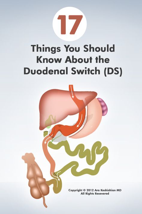 Bariatric Recipes Ds Loop, Duodenal Switch Before And After, Duodenal Switch Diet, Duodenal Switch Recipes, Bariatric Recipes Duodenal Switch, Gastric Bypass Pouch Reset Diet, Duodenal Switch Surgery, Reset Gastric Bypass Pouch, Full Liquid Diet