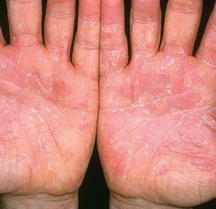 Skin Peeling On Hands, Nail Disorders, Writing Apps, Skin Condition, Skin Disorders, Peeling Skin, Nail Fungus, Dry Nails, Nails Magazine